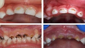 پوسیدگی دندان‌های کودک چگونه شکل می‌گیرد؟