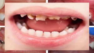 ترمیم پوسیدگی دندان بیماری را درمان نمی‌کند!