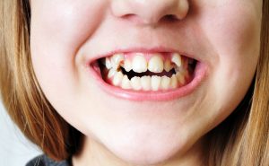 دندان اضافی در کودکان