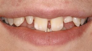 تاثیر دندان کج و نامتناسب بر سلامت عمومی کودک