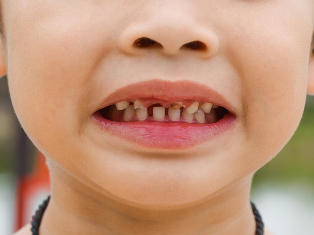 ترمیم پوسیدگی‌ و زیبایی دندان‌های کودکان
