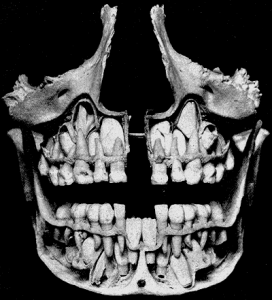 برش مقطعی از دندان دائمی که در بالا و پایین دندان های شیری قرار دارند.