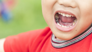 روکش دندان شیری برای کودکان