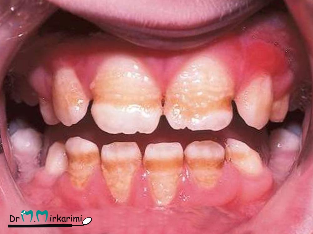 اختلالات ساختاری دندان‌ها چگونه به وجود می‌آیند؟