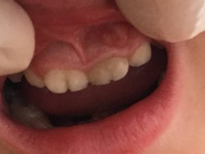 دندان تقسیم‌شده