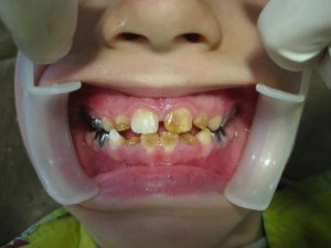 آملوژنز ایمپرفکتا دندان‌های شیری و دائمی را درگیر می‌کند