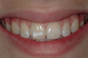 دندان هیپوپلاستیک