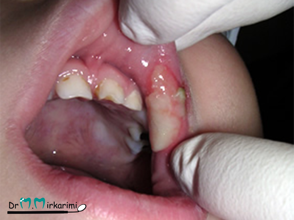 گاز گرفتن لپ و زخم لب بعد از کار دندانپزشکی کودکان